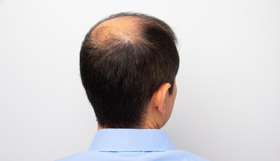 Does Being Bald Hurt You in a Job Interview?