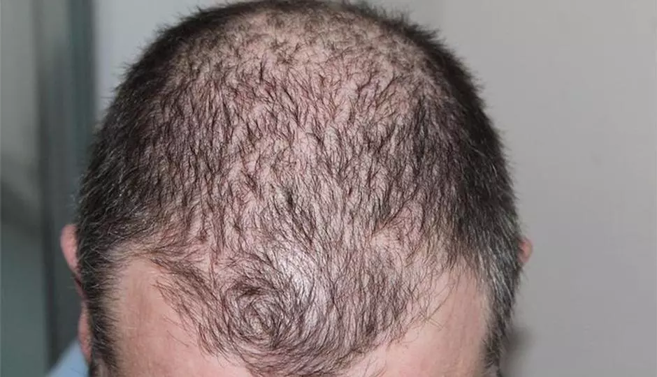 How Laser Hair Therapy Helps Alopecia